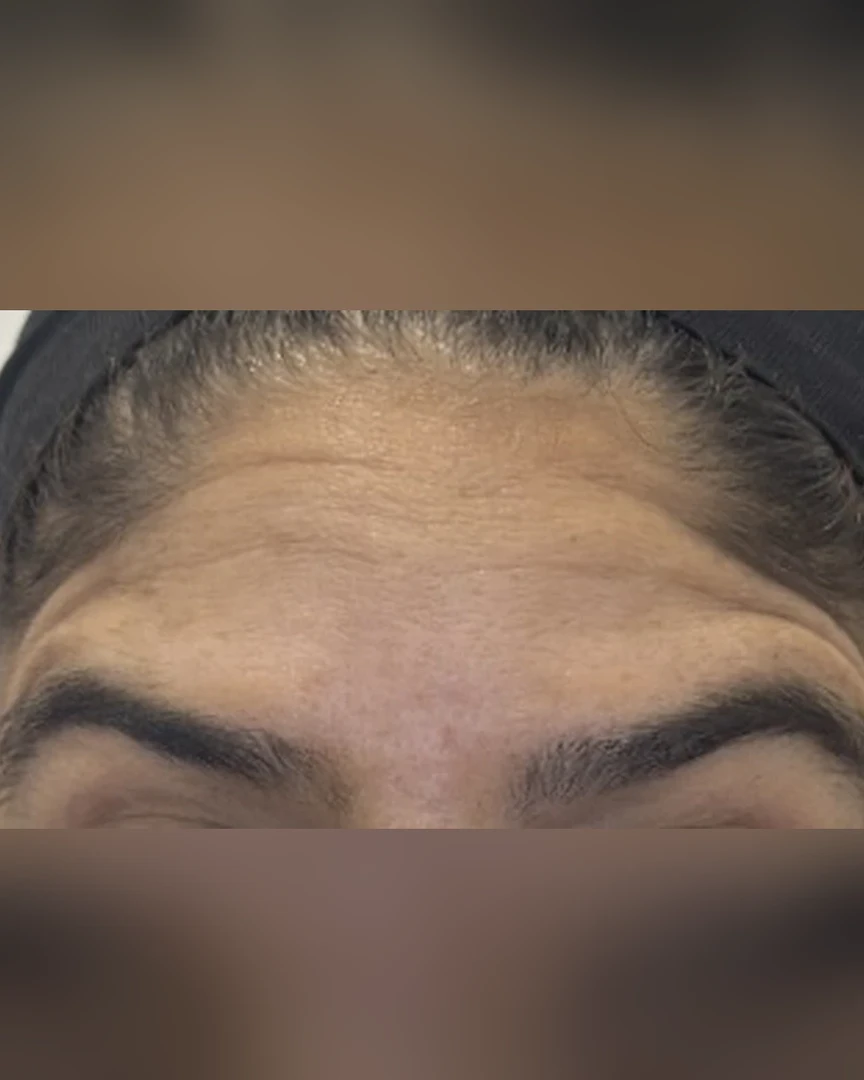After טיפול בוטוקס treatment