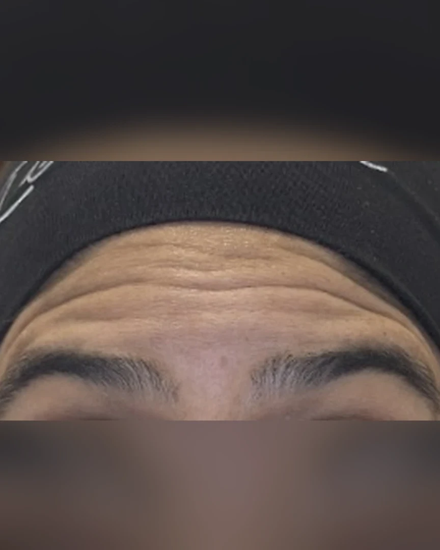 Before טיפול בוטוקס treatment