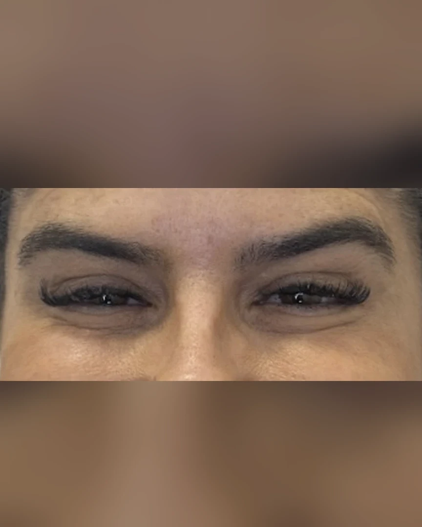 After טיפול בוטוקס treatment