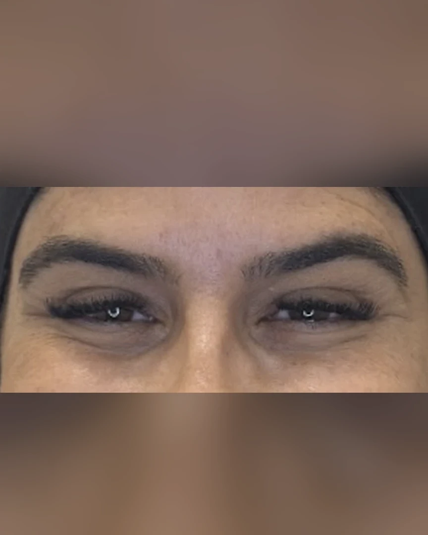 Before טיפול בוטוקס treatment