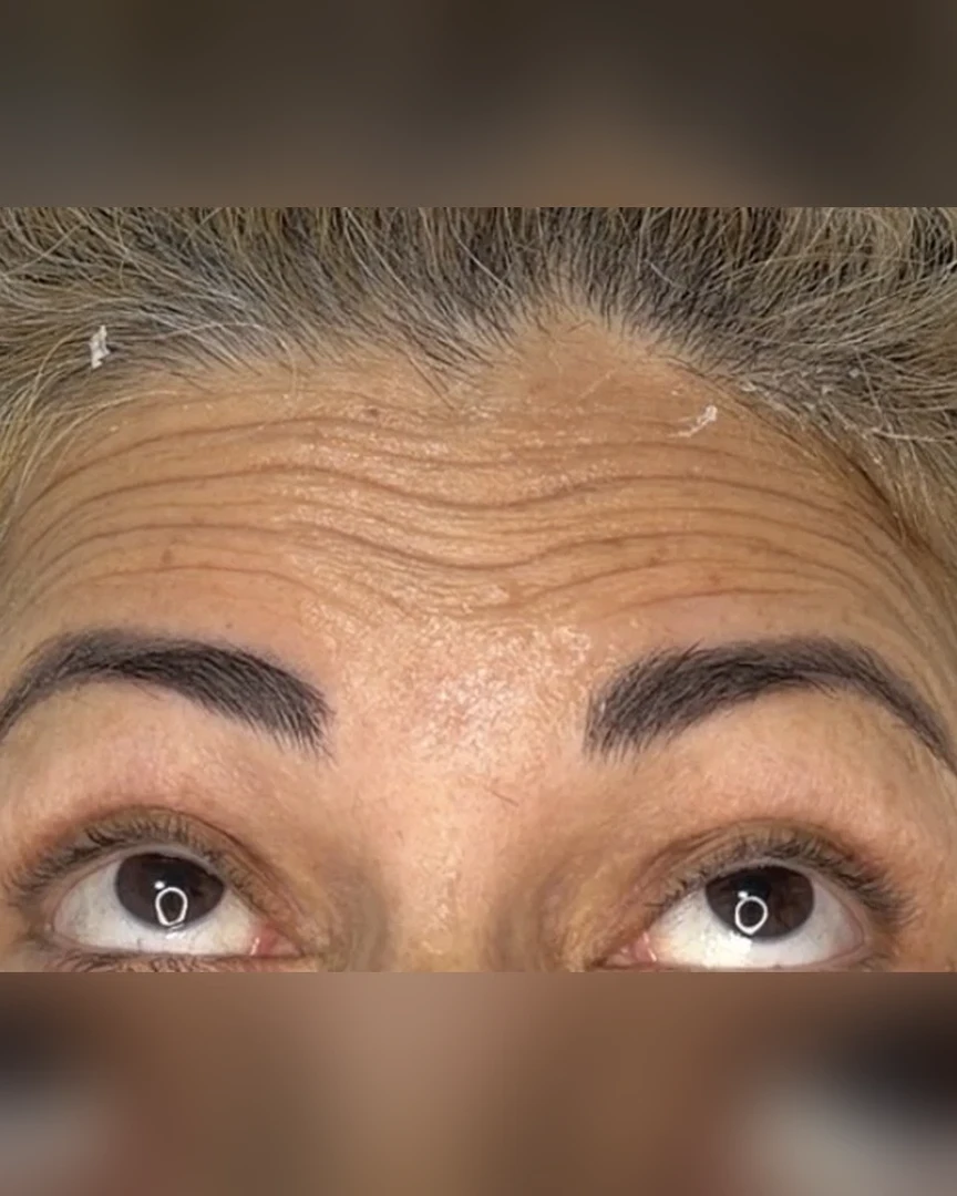 Before טיפול בוטוקס treatment