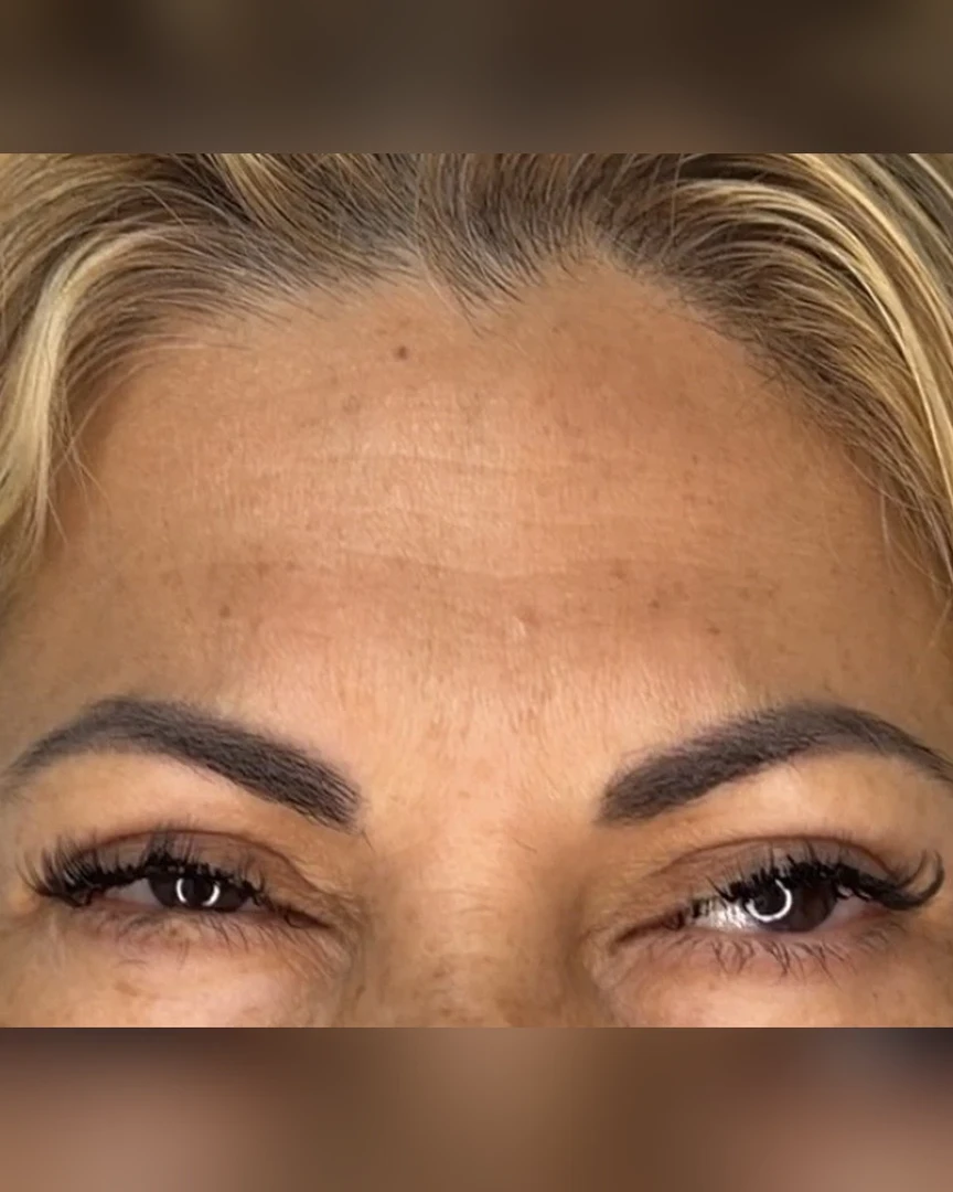 After טיפול בוטוקס treatment