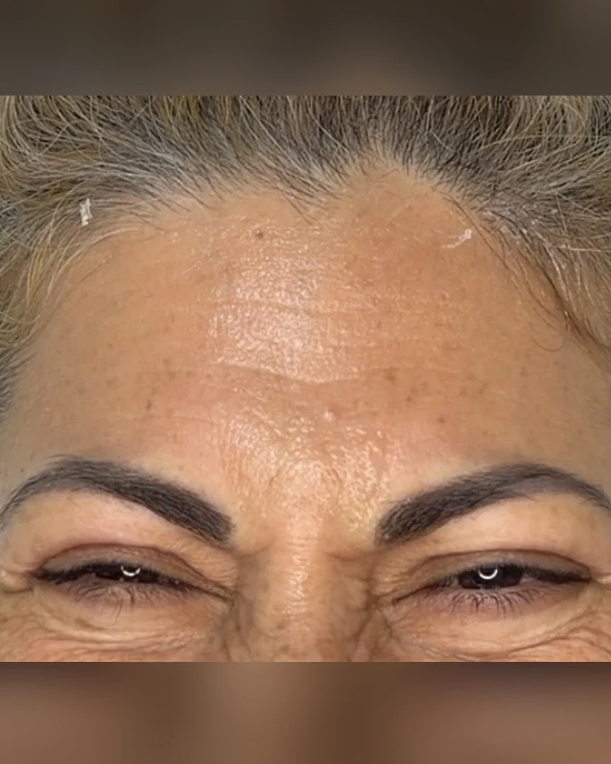 Before טיפול בוטוקס treatment