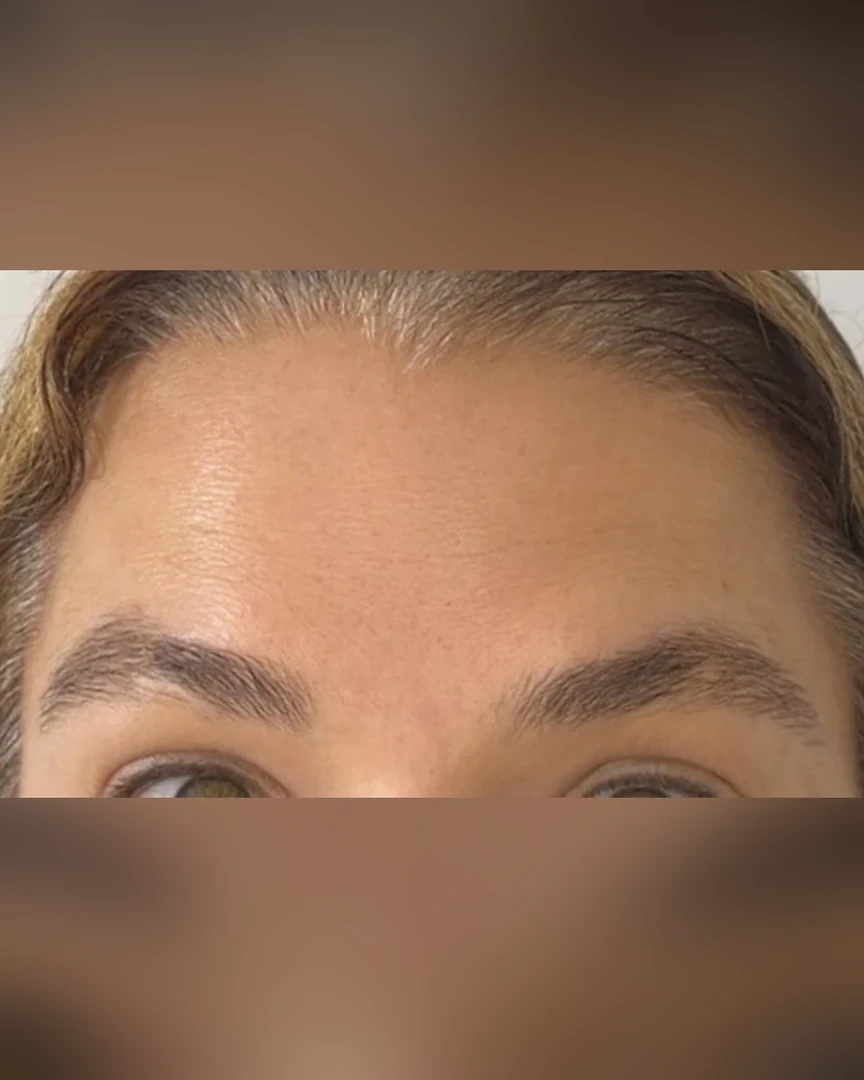 After טיפול בוטוקס treatment