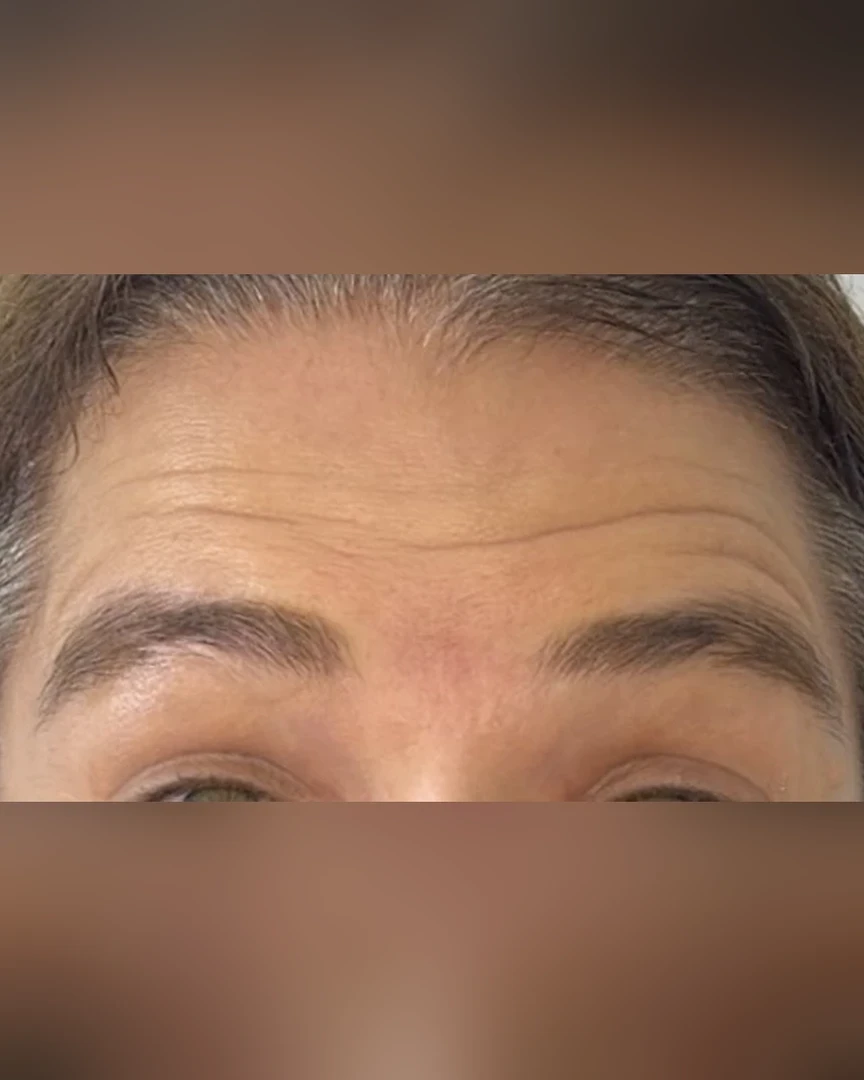 Before טיפול בוטוקס treatment