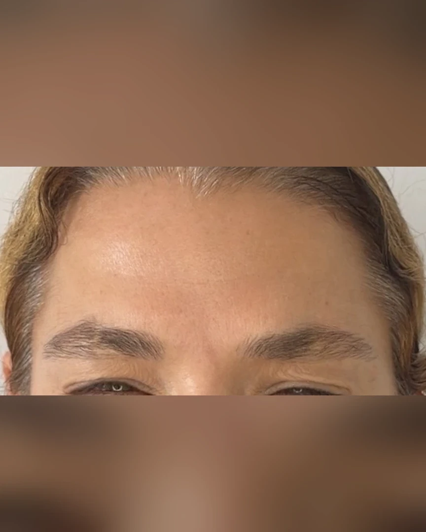 After טיפול בוטוקס treatment
