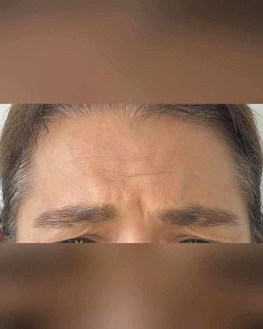 Before טיפול בוטוקס treatment