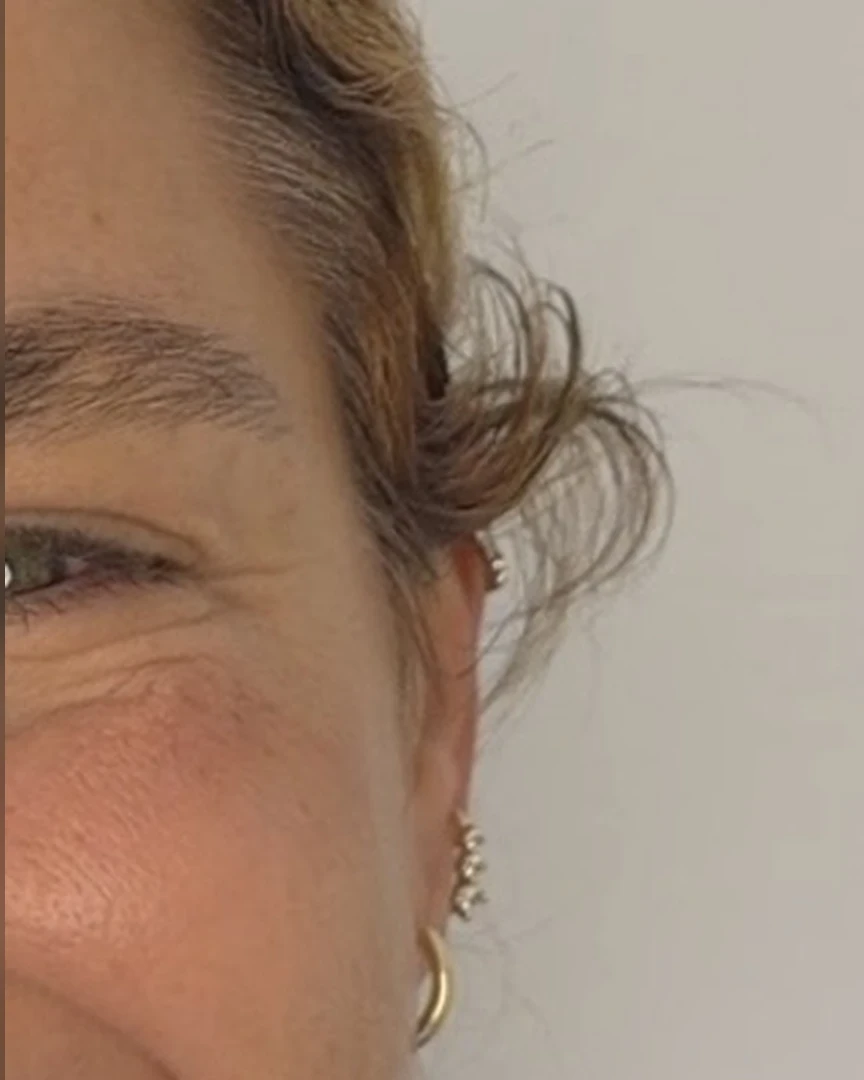 After טיפול בוטוקס treatment