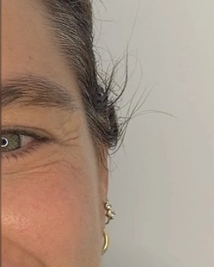 Before טיפול בוטוקס treatment