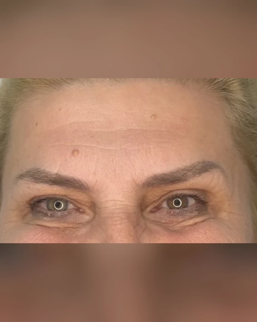 After טיפול בוטוקס treatment