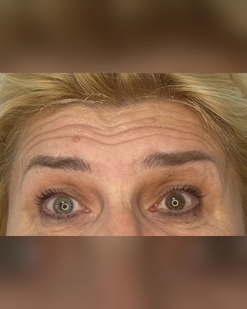 Before טיפול בוטוקס treatment