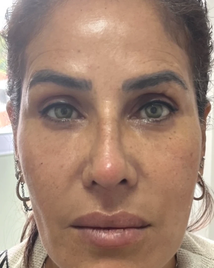 After פיסול פנים treatment