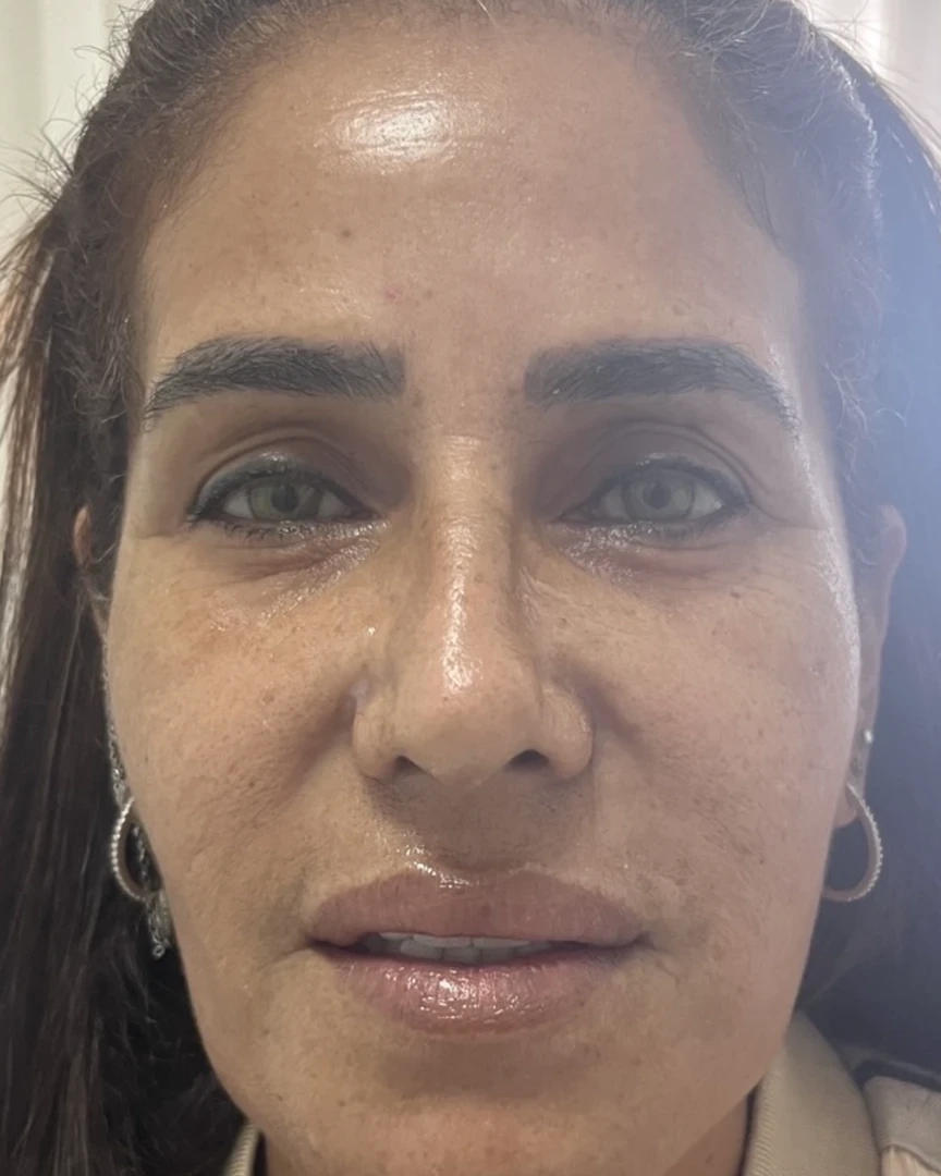 Before פיסול פנים treatment