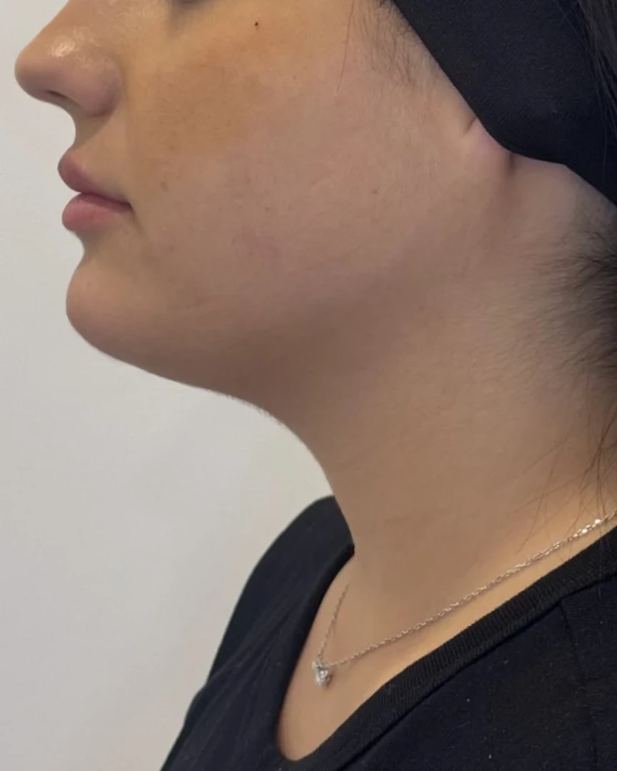 After קו לסת treatment