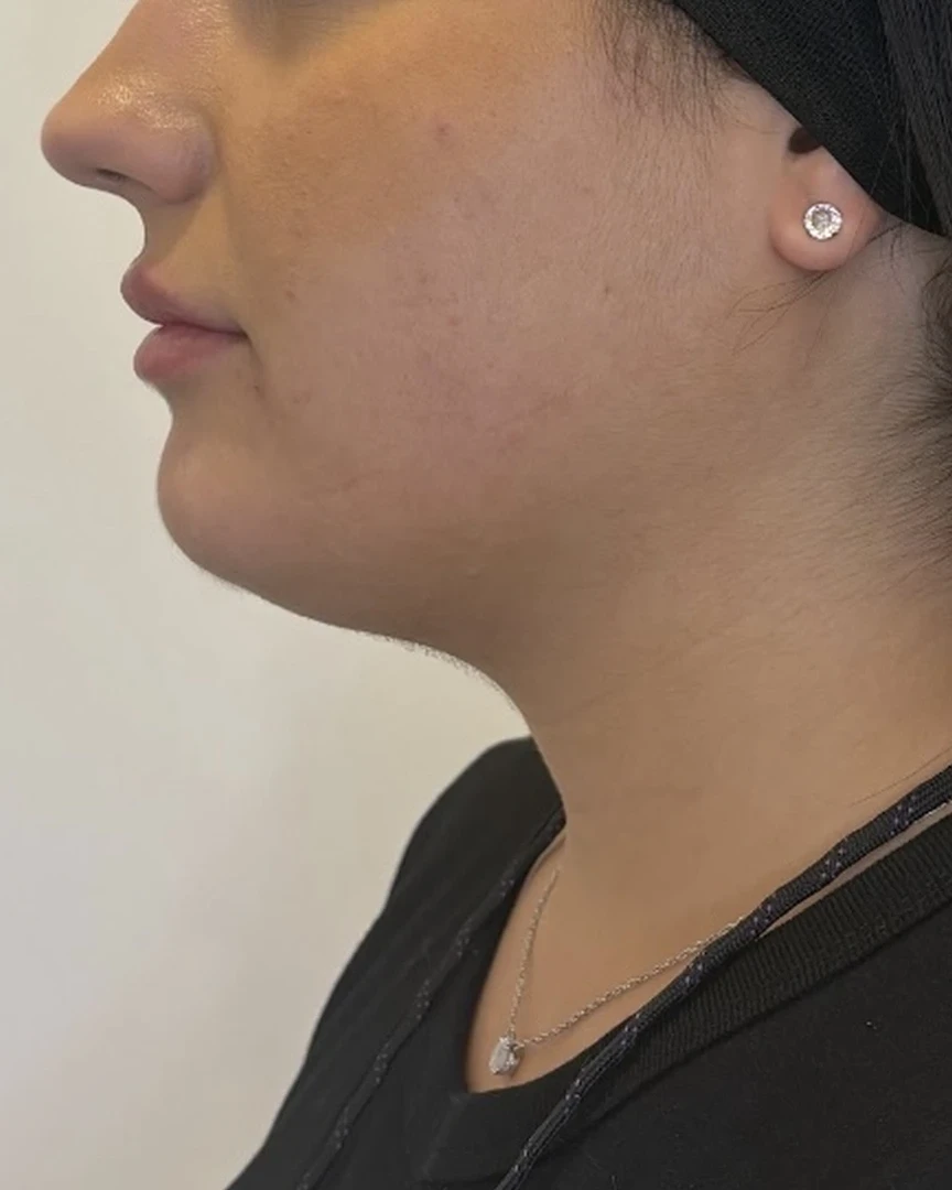 Before קו לסת treatment