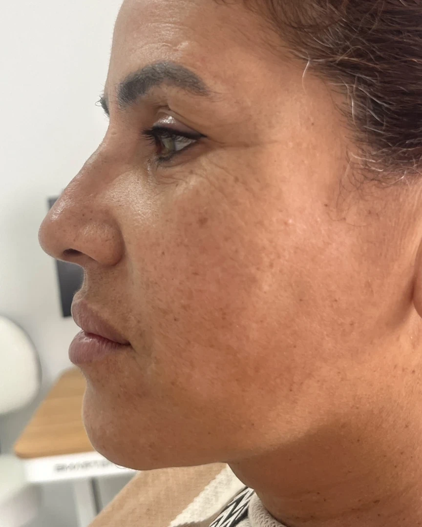 Before קו לסת treatment