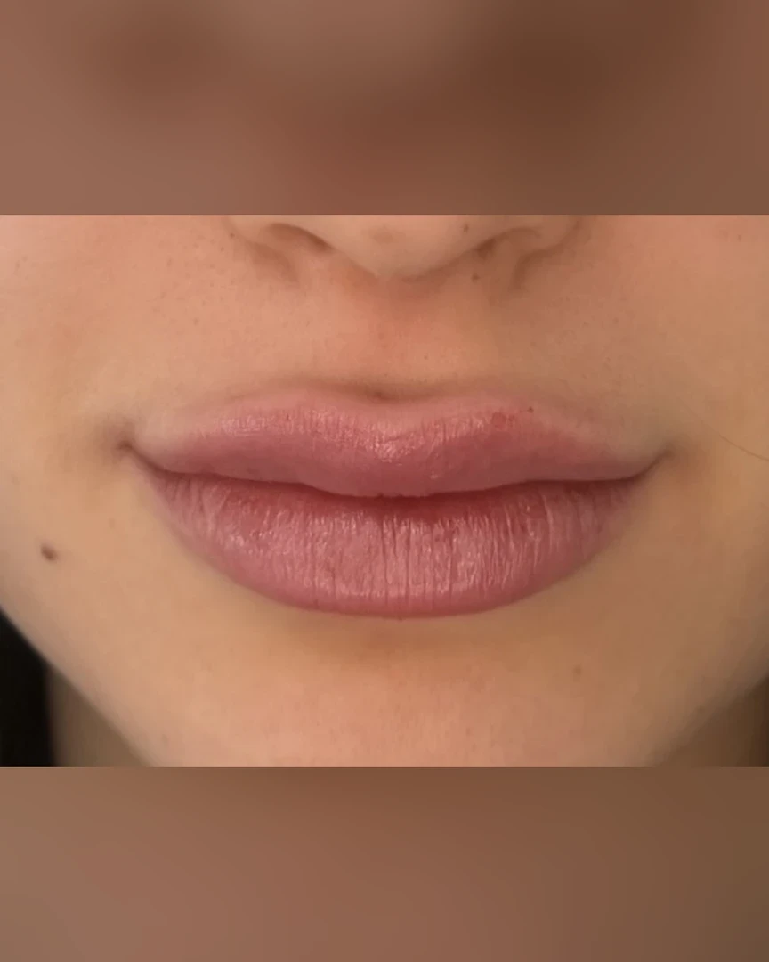 After עיצוב שפתיים treatment