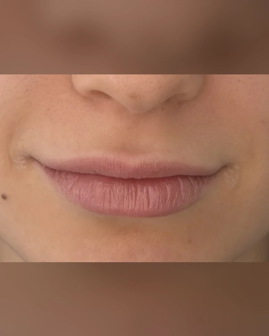 Before עיצוב שפתיים treatment