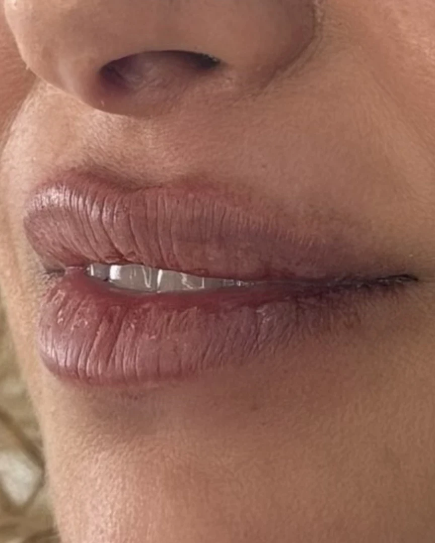 After עיצוב שפתיים treatment