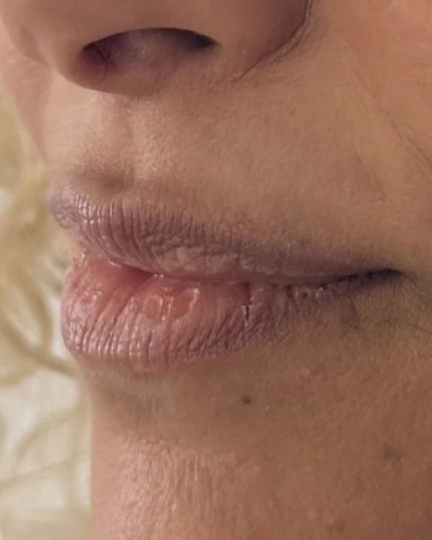 Before עיצוב שפתיים treatment