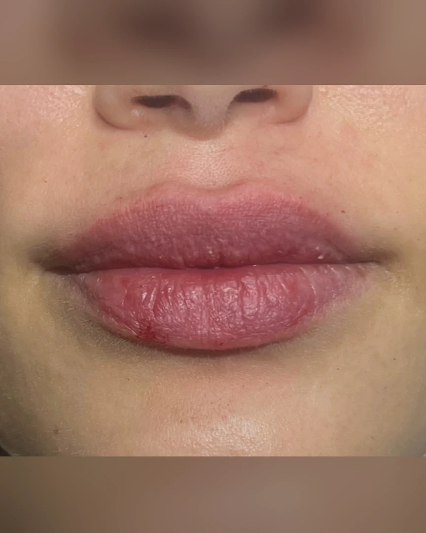 After עיצוב שפתיים treatment