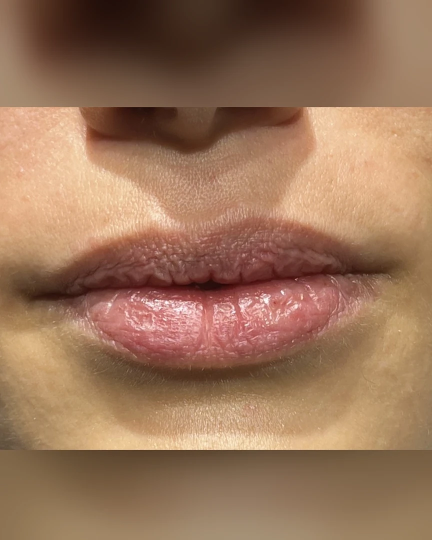 Before עיצוב שפתיים treatment