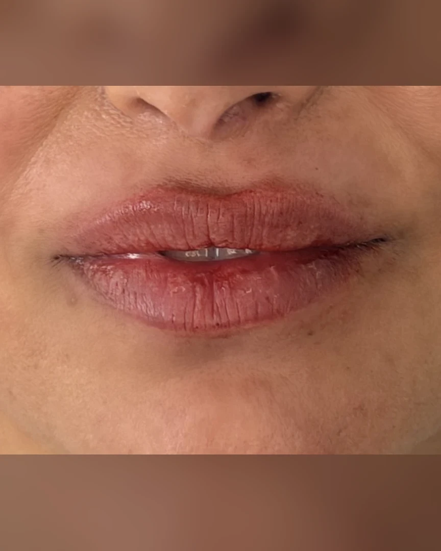 After עיצוב שפתיים treatment
