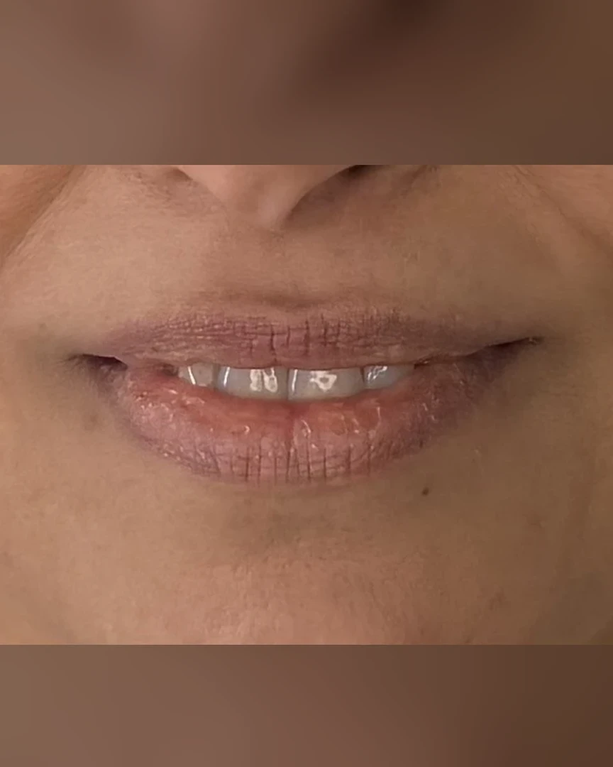 Before עיצוב שפתיים treatment