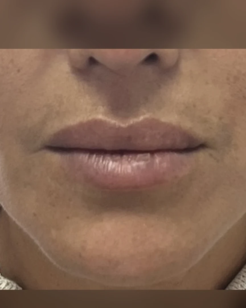 After עיצוב שפתיים treatment