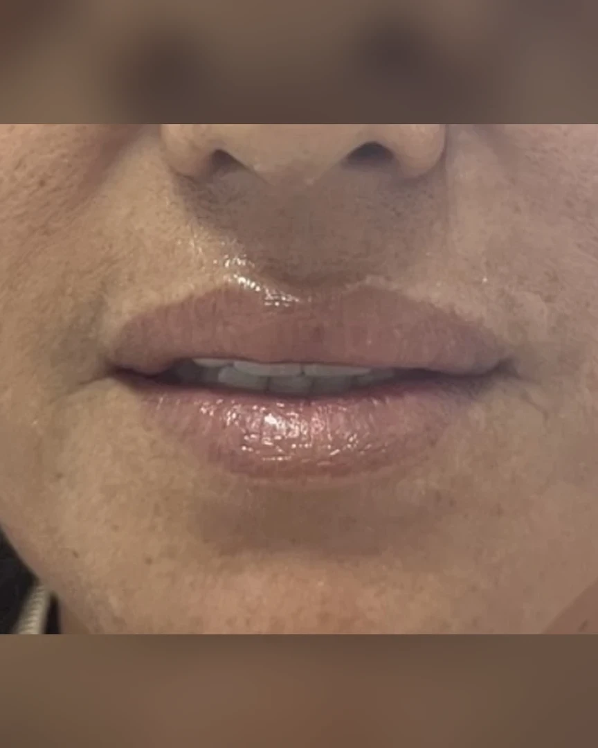 Before עיצוב שפתיים treatment