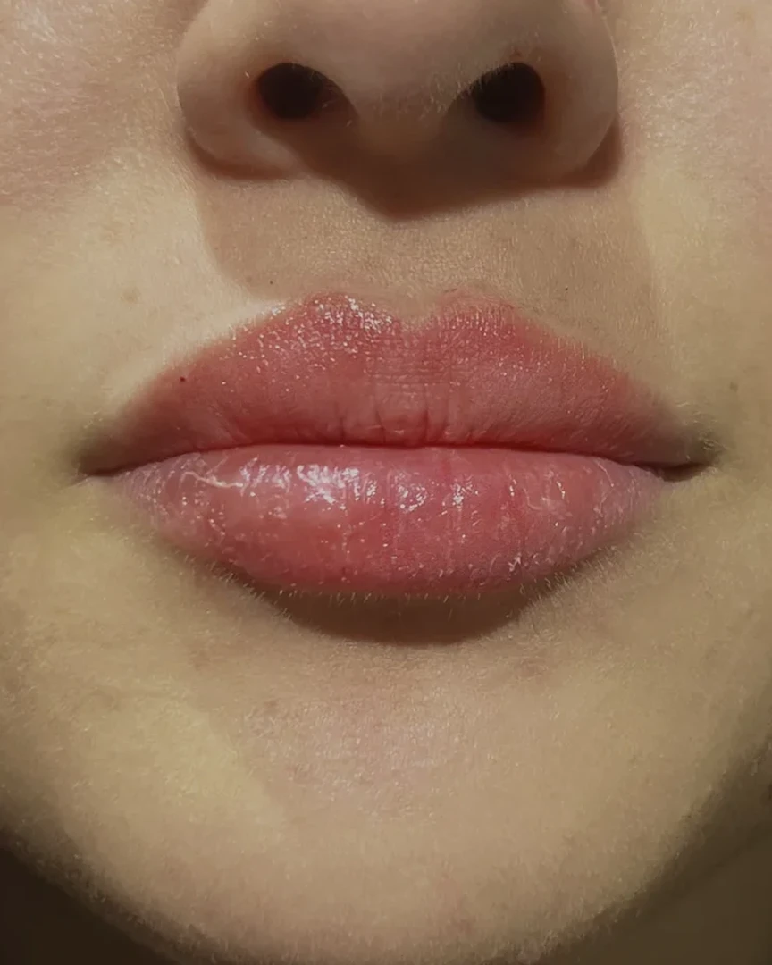 After עיצוב שפתיים treatment