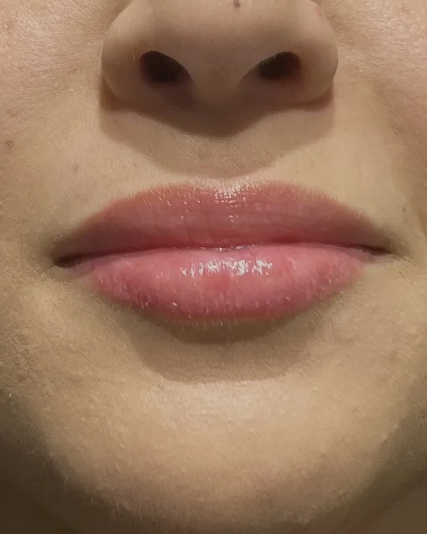Before עיצוב שפתיים treatment