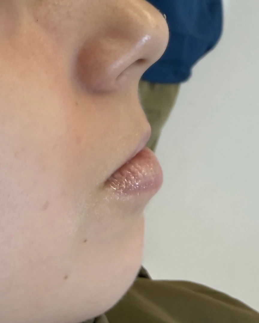 Before עיצוב שפתיים treatment