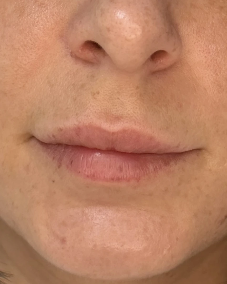 Before עיצוב שפתיים treatment
