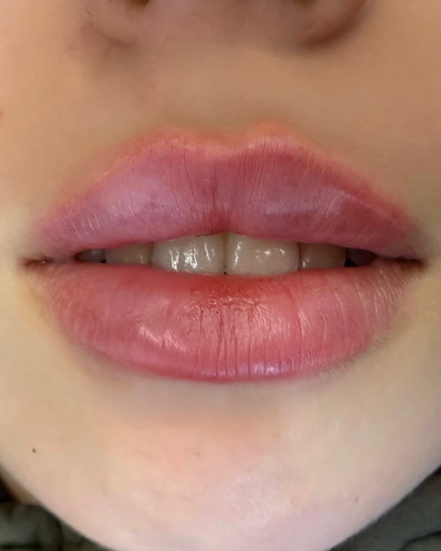 After עיצוב שפתיים treatment