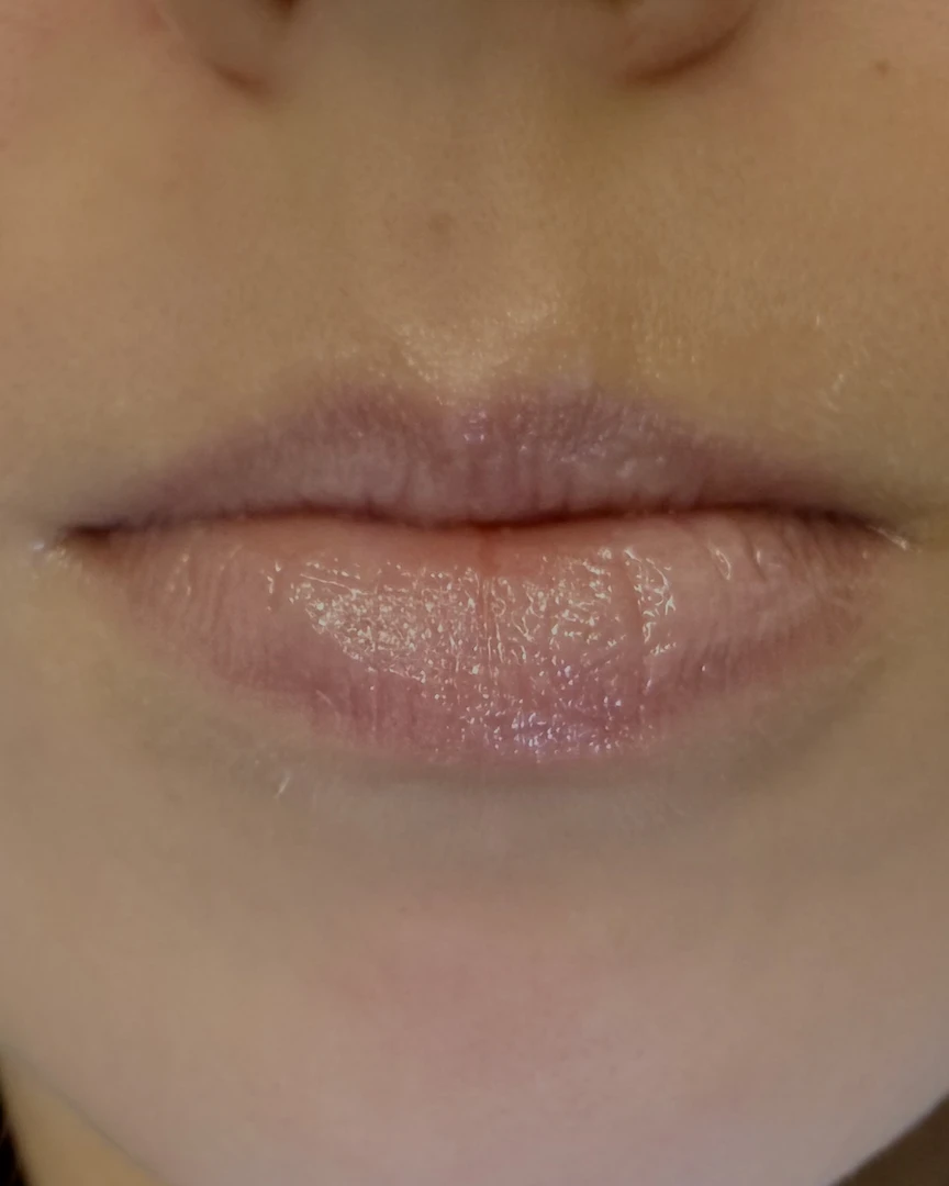 Before עיצוב שפתיים treatment